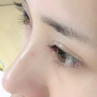 0日目の経過画像（3枚目）