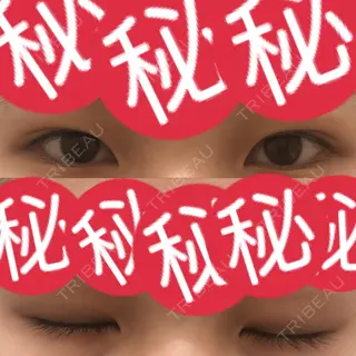 111日目の経過画像（2枚目）