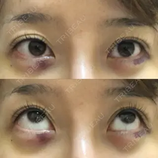 2日目の経過画像（1枚目）