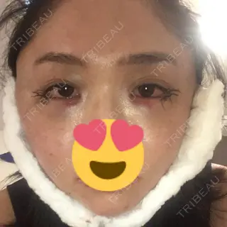 1日目の経過画像（1枚目）