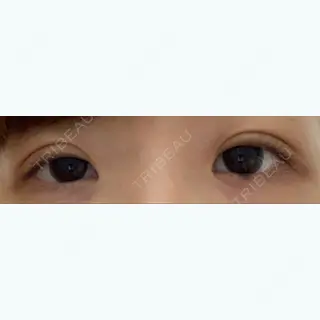 6日目の経過画像（1枚目）