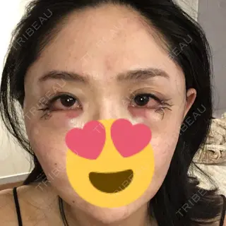 1日目の経過画像（1枚目）