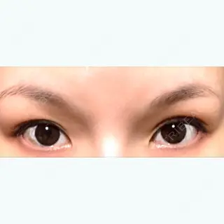 14日目の経過画像（1枚目）
