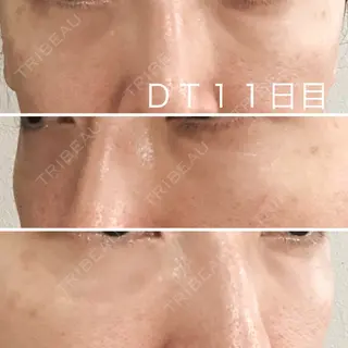 11日目の経過画像（1枚目）