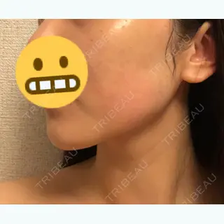 0日目の経過画像（2枚目）