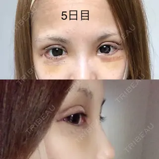 5日目の経過画像（1枚目）