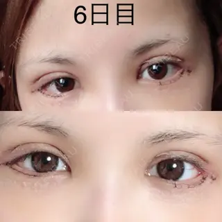 6日目の経過画像（1枚目）
