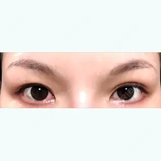 15日目の経過画像（1枚目）