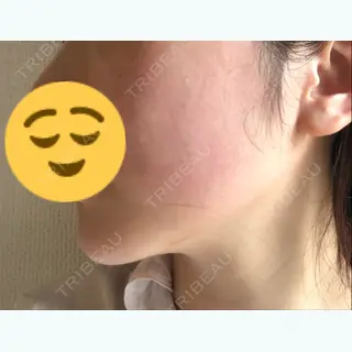 1日目の経過画像（3枚目）