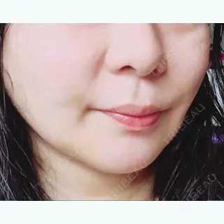 3日目の経過画像（1枚目）