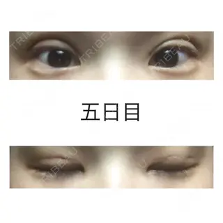 5日目の経過画像（1枚目）