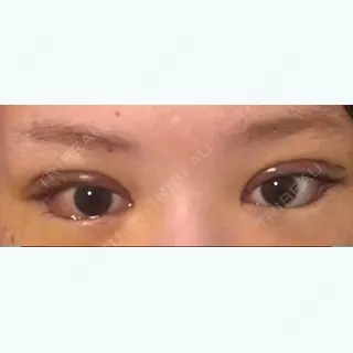 5日目の経過画像（1枚目）