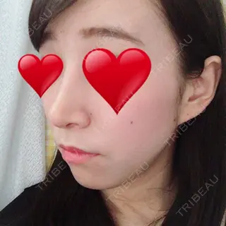 25日目の経過画像（1枚目）