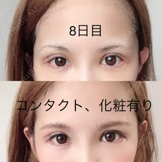 8日目の経過画像（1枚目）
