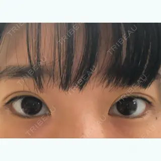 4日目の経過画像（1枚目）