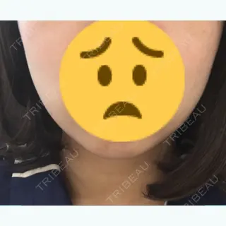 0日目の経過画像（1枚目）