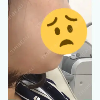 0日目の経過画像（3枚目）