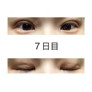 7日目の経過画像（1枚目）