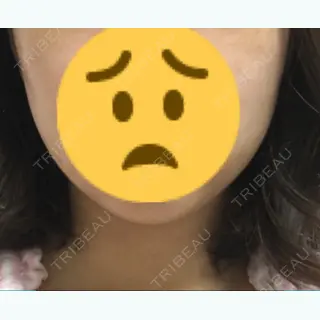 0日目の経過画像（1枚目）