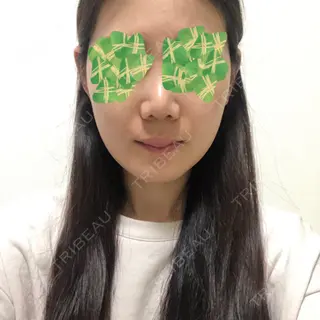 30日目の経過画像（1枚目）