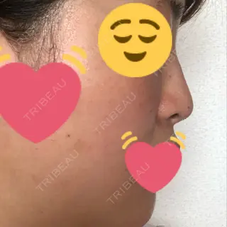 0日目の経過画像（2枚目）