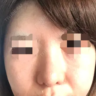 14日目の経過画像（1枚目）