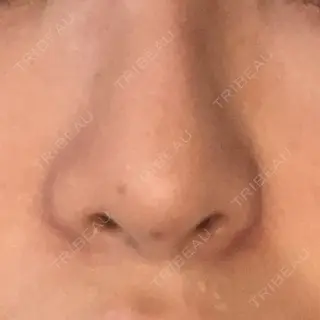 1日目の経過画像（1枚目）