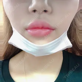 0日目の経過画像（1枚目）