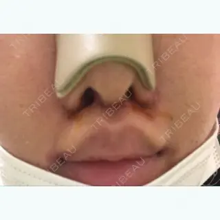 11日目の経過画像（1枚目）