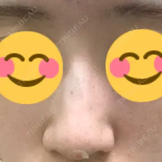 0日目の経過画像（3枚目）