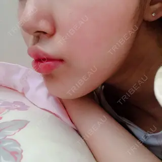 2日目の経過画像（2枚目）