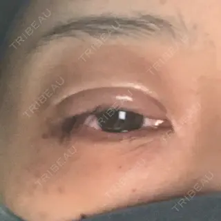 0日目の経過画像（1枚目）
