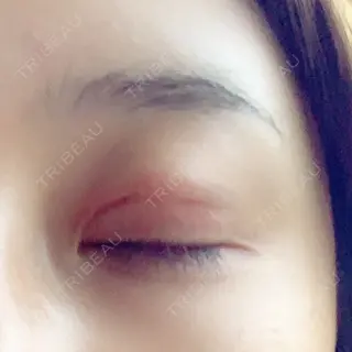 4日目の経過画像（2枚目）