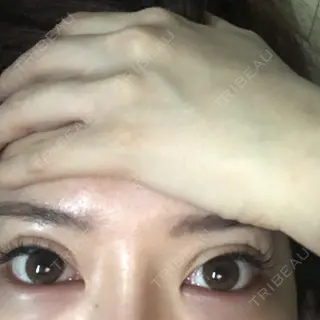 7日目の経過画像（1枚目）