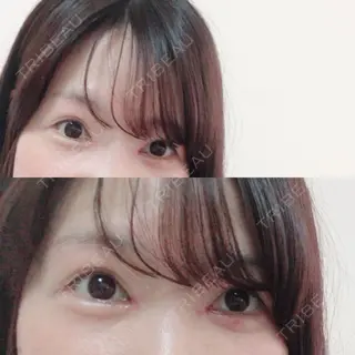 14日目の経過画像（1枚目）