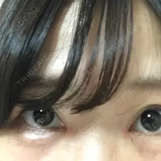16日目の経過画像（1枚目）