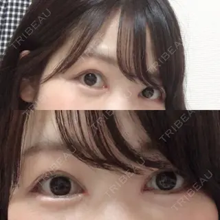 30日目の経過画像（1枚目）