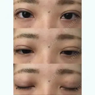 5日目の経過画像（1枚目）