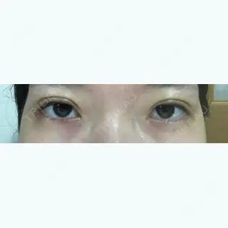 3日目の経過画像（1枚目）