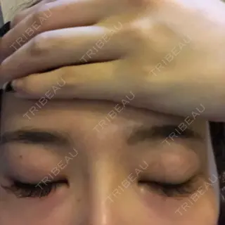 8日目の経過画像（2枚目）