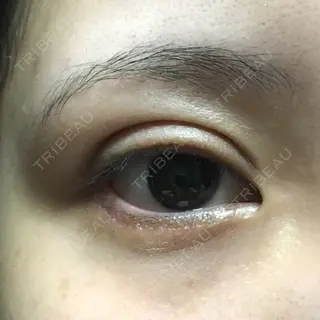 33日目の経過画像（1枚目）