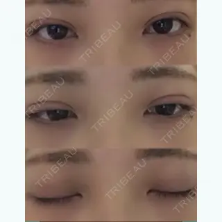 5日目の経過画像（1枚目）