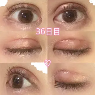 35日目の経過画像（1枚目）