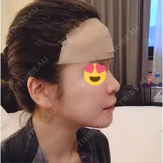 0日目の経過画像（1枚目）