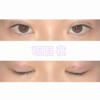 1日目の経過画像（2枚目）