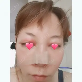 2日目の経過画像（1枚目）