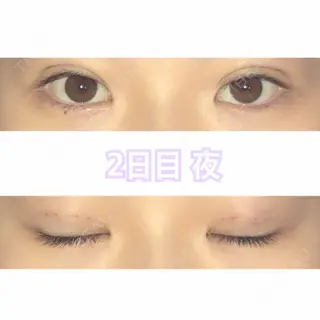 2日目の経過画像（2枚目）