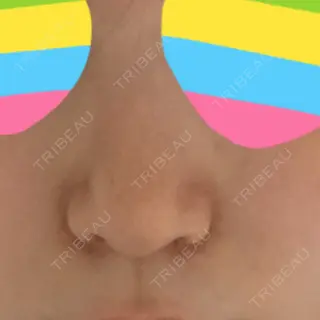 7日目の経過画像（2枚目）
