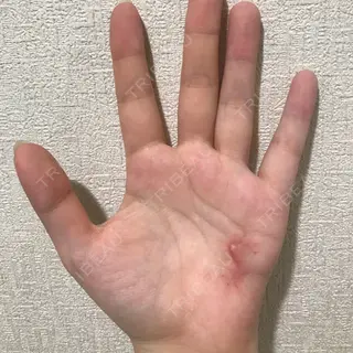 33日目の経過画像（1枚目）