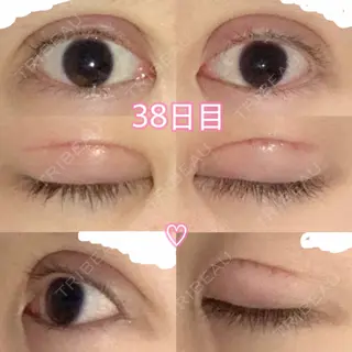 37日目の経過画像（1枚目）
